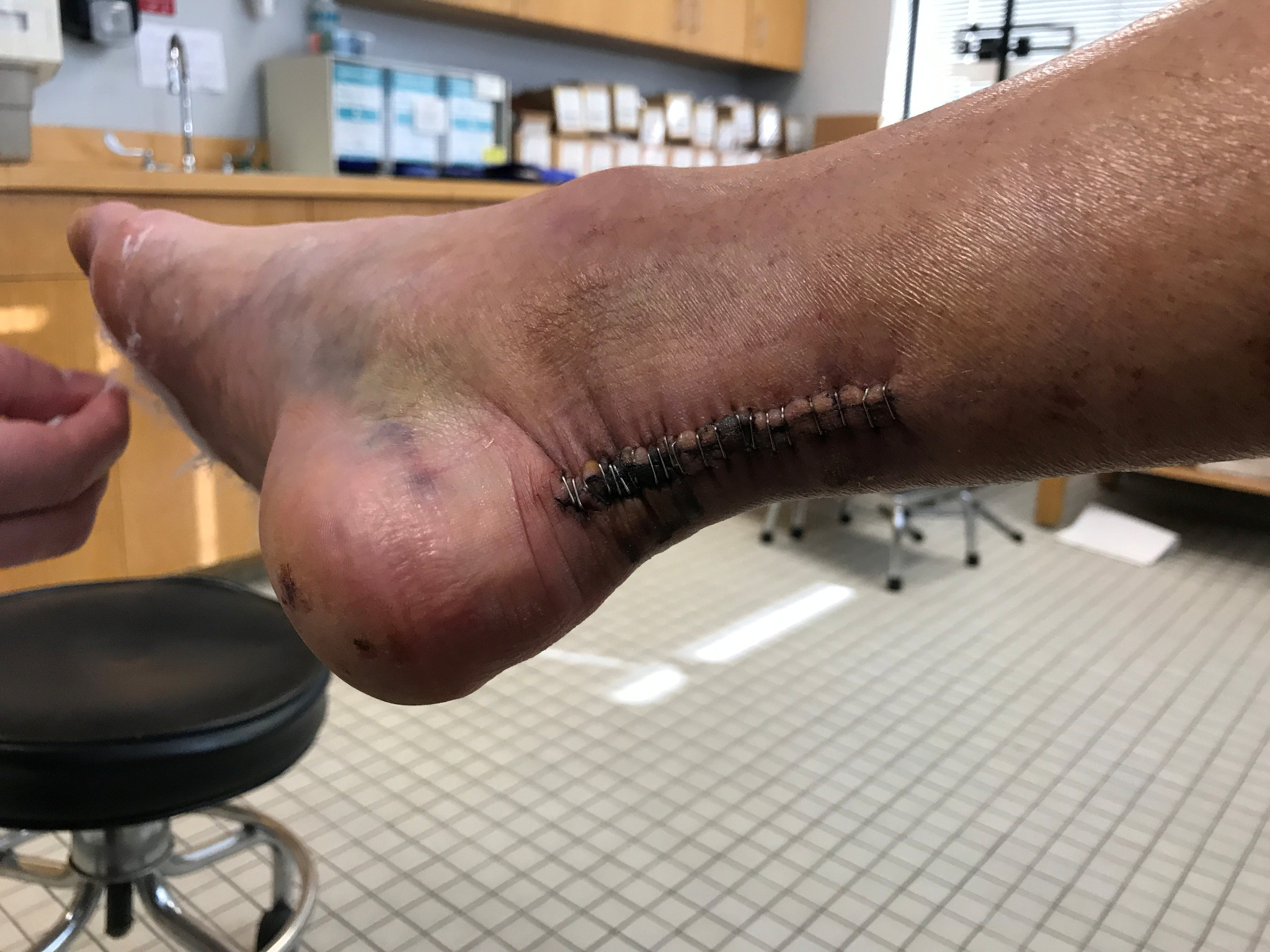 Kerry's post-operative Achilles photo